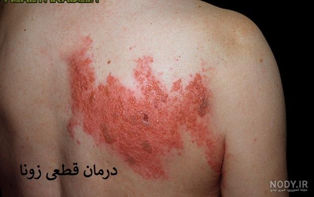 پماد برای زونا پماد برای زونا