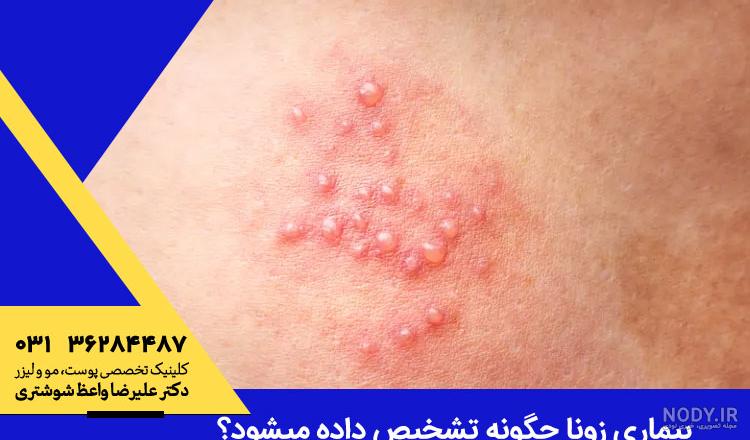 پماد هیدروکورتیزون برای زونا پماد هیدروکورتیزون برای زونا