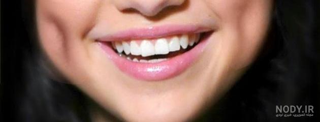 برای چال شدن لپ جنین چی بخوریم برای چال شدن لپ جنین چی بخوریم