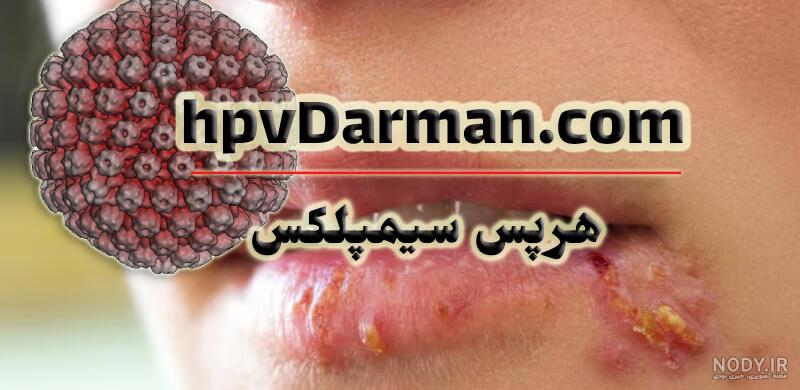 از کجا بفهمیم تبخال تناسلی داریم نی نی سایت از کجا بفهمیم تبخال تناسلی داریم نی نی سایت