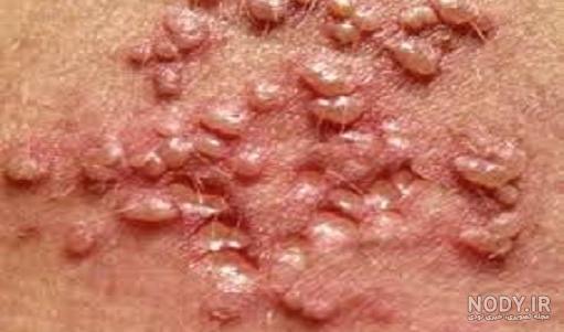 اچ اس وی چیست اچ اس وی چیست