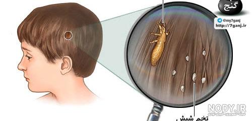 درمان شپش سر با روغن زیتون درمان شپش سر با روغن زیتون