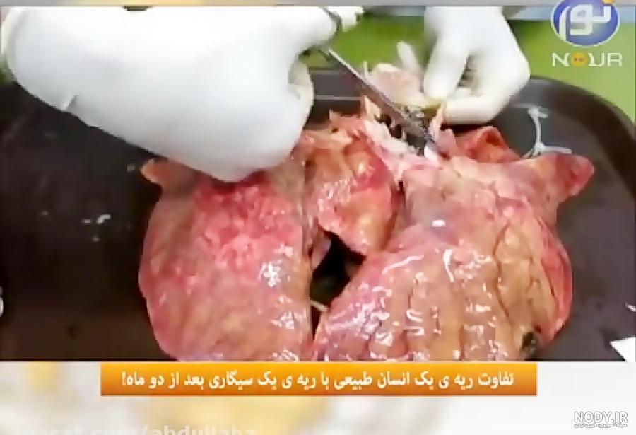 ریه فرد سیگاری بعد از ترک