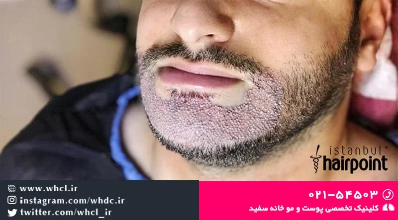 بهترین قرص برای رشد ریش بهترین قرص برای رشد ریش