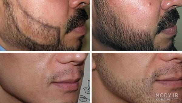 تصاویر کاشت ریش تصاویر کاشت ریش