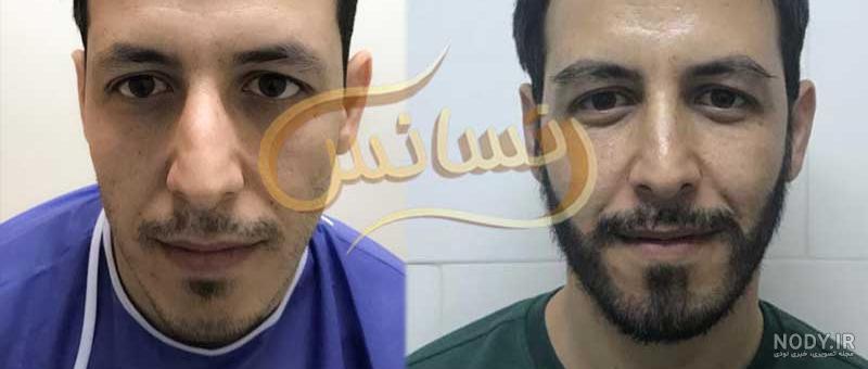 جای زخم کاشت ریش