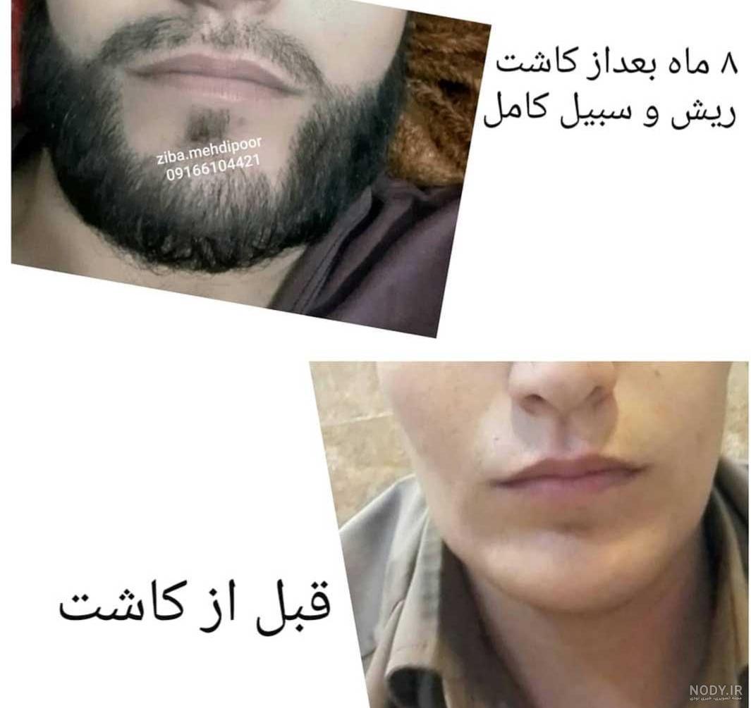 دوره نقاهت کاشت ریش دوره نقاهت کاشت ریش