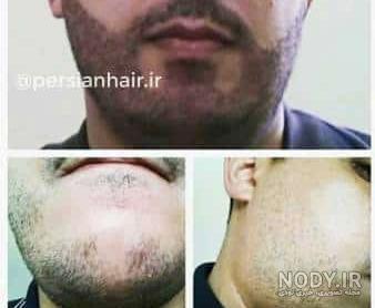 سن کاشت ریش سن کاشت ریش
