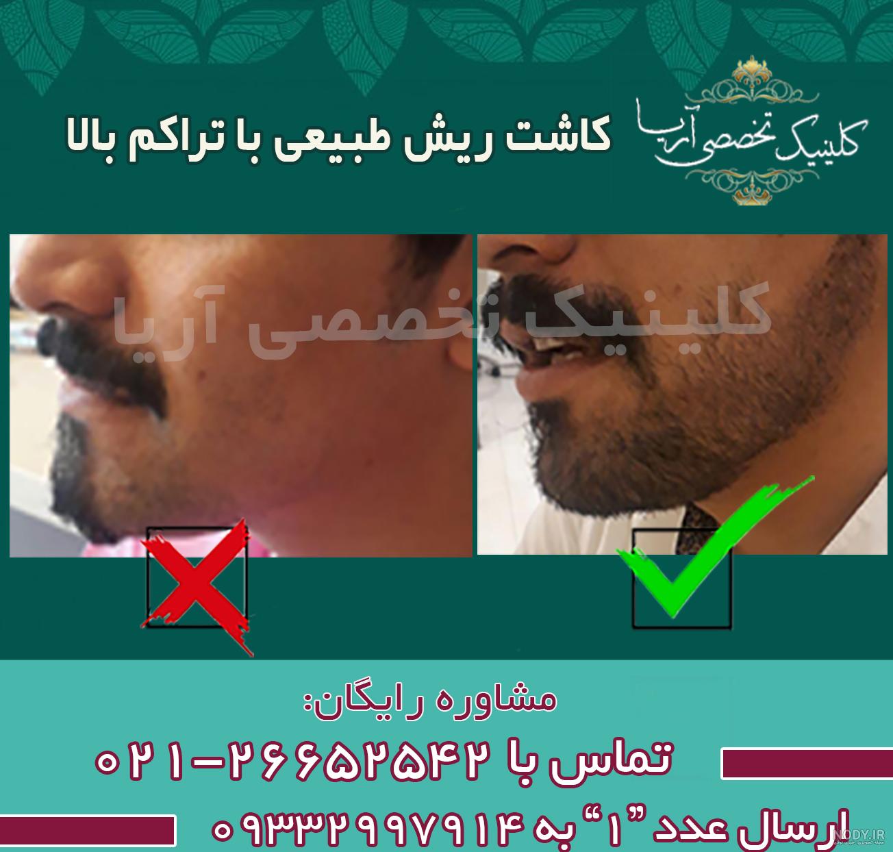 عکس از کاشت ریش عکس از کاشت ریش