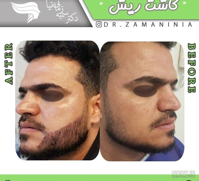 عکس ریش کاشته شده عکس ریش کاشته شده