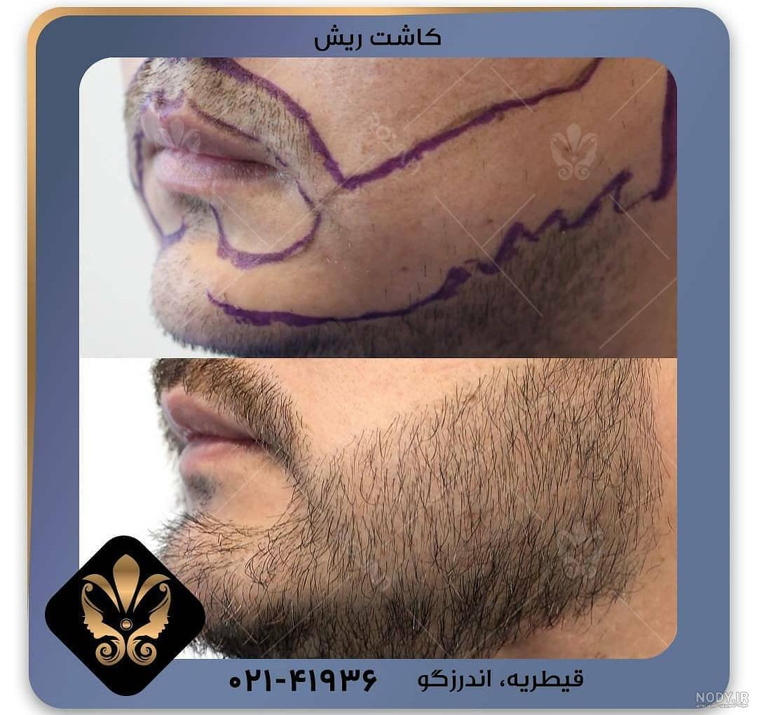 عکس کاشت ریش و سبیل عکس کاشت ریش و سبیل