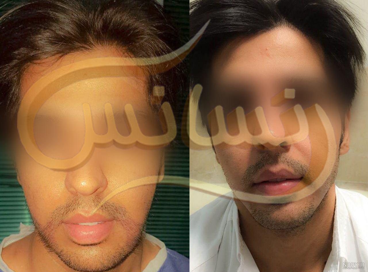 عکس کاشت مو از ریش عکس کاشت مو از ریش