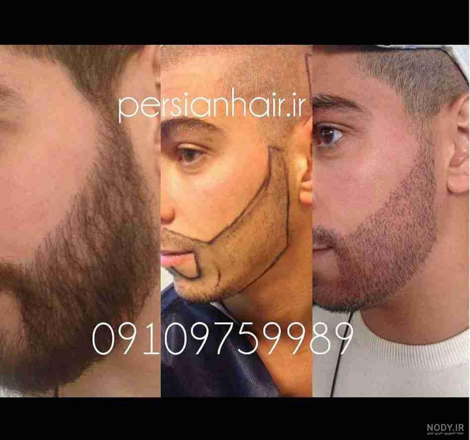 عکسهای کاشت ریش عکسهای کاشت ریش