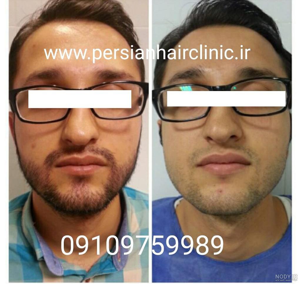 فیلم کاشت ریش به روش sut فیلم کاشت ریش به روش sut