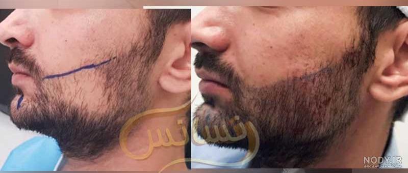 محلول پرپشت کننده ریش