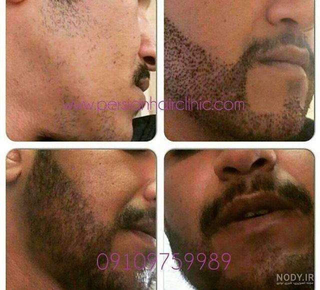 مشاوره رایگان کاشت ریش مشاوره رایگان کاشت ریش