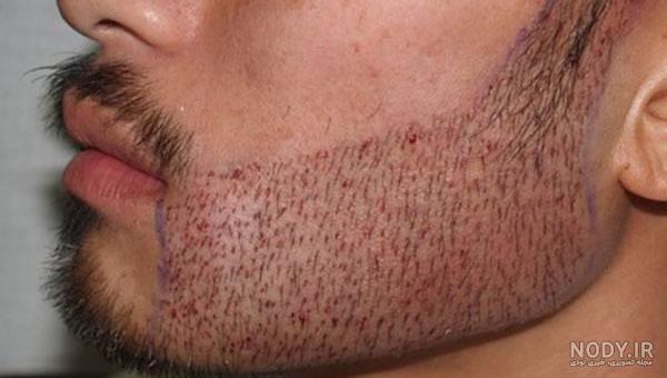 نتایج کاشت ریش نتایج کاشت ریش