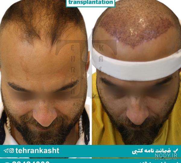 نظرات در مورد کاشت ریش نظرات در مورد کاشت ریش