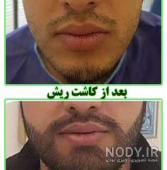 هزینه کاشت ریش هزینه کاشت ریش