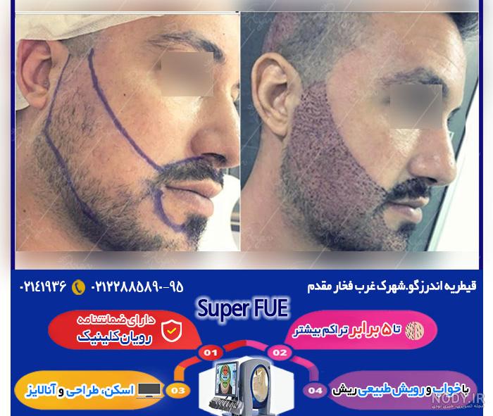 کاشت ریش به روش sut کاشت ریش به روش sut