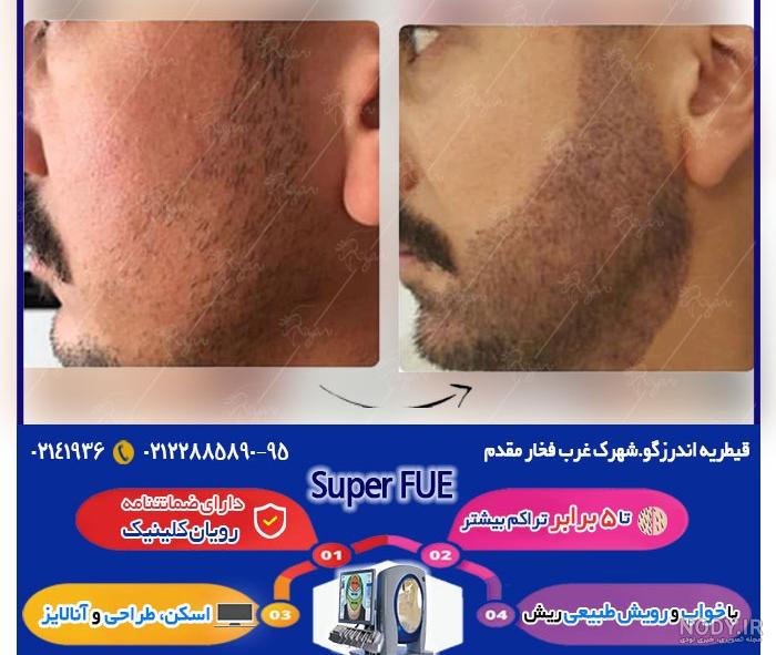 کاشت ریش در قم کاشت ریش در قم