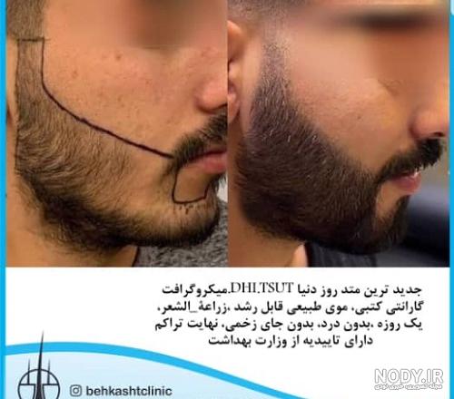 کاشت ریش در یزد کاشت ریش در یزد