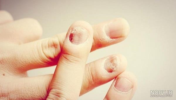 عوارض لیکوئید کاشت ناخن عوارض لیکوئید کاشت ناخن