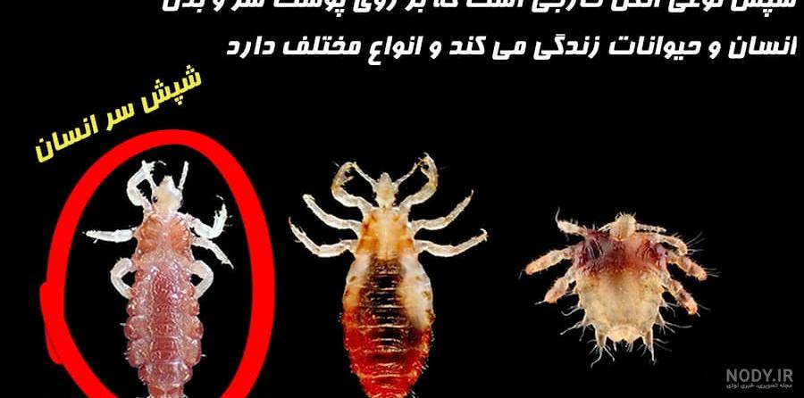 شپش سیاه رنگ سر شپش سیاه رنگ سر