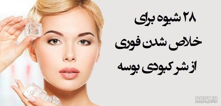 کبودی عاشقانه کبودی عاشقانه
