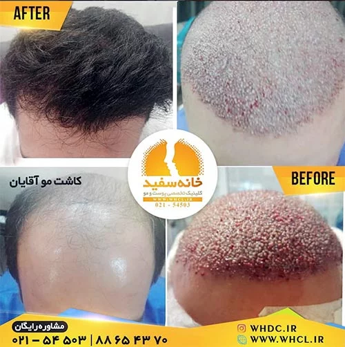 عکس کاشت مو