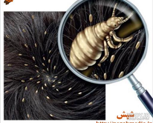 فیلم شپش سر کودکان فیلم شپش سر کودکان