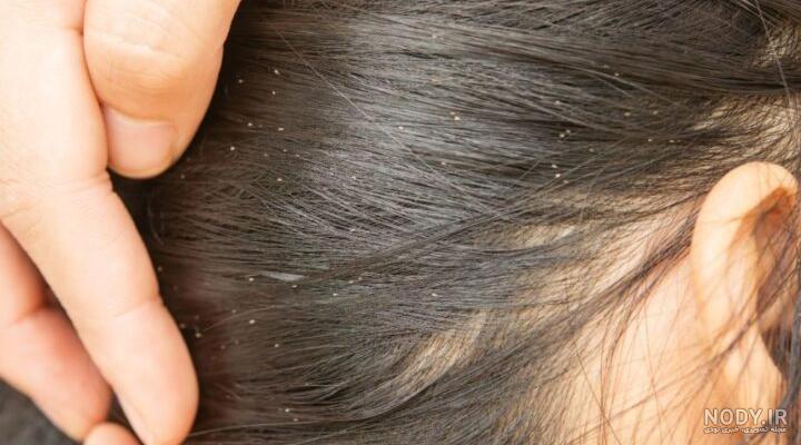نمک برای از بین بردن شپش
