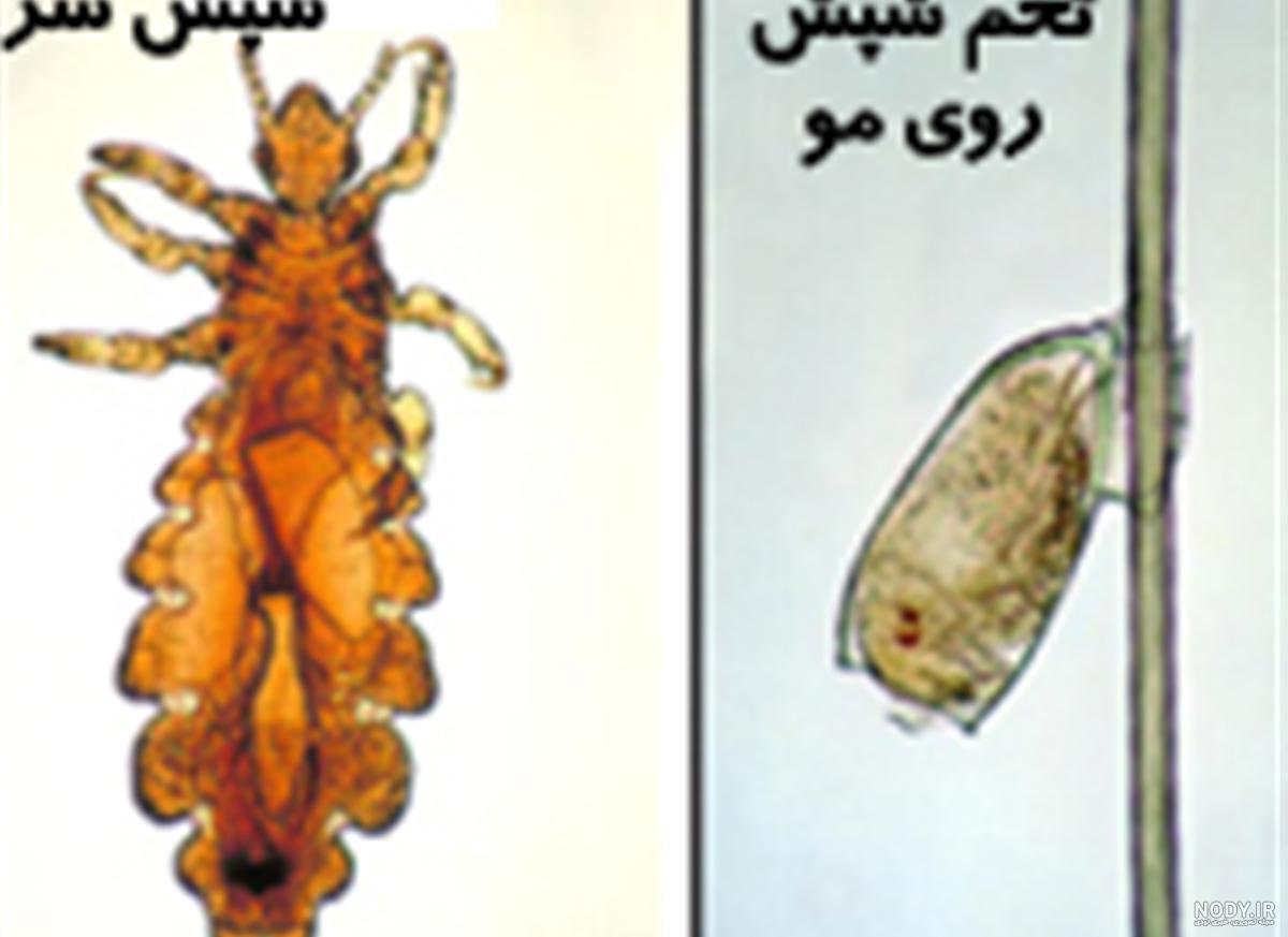 دشمن شپش چیست دشمن شپش چیست