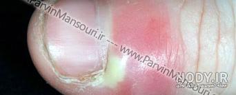 پماد برای عفونت ناخن پا پماد برای عفونت ناخن پا