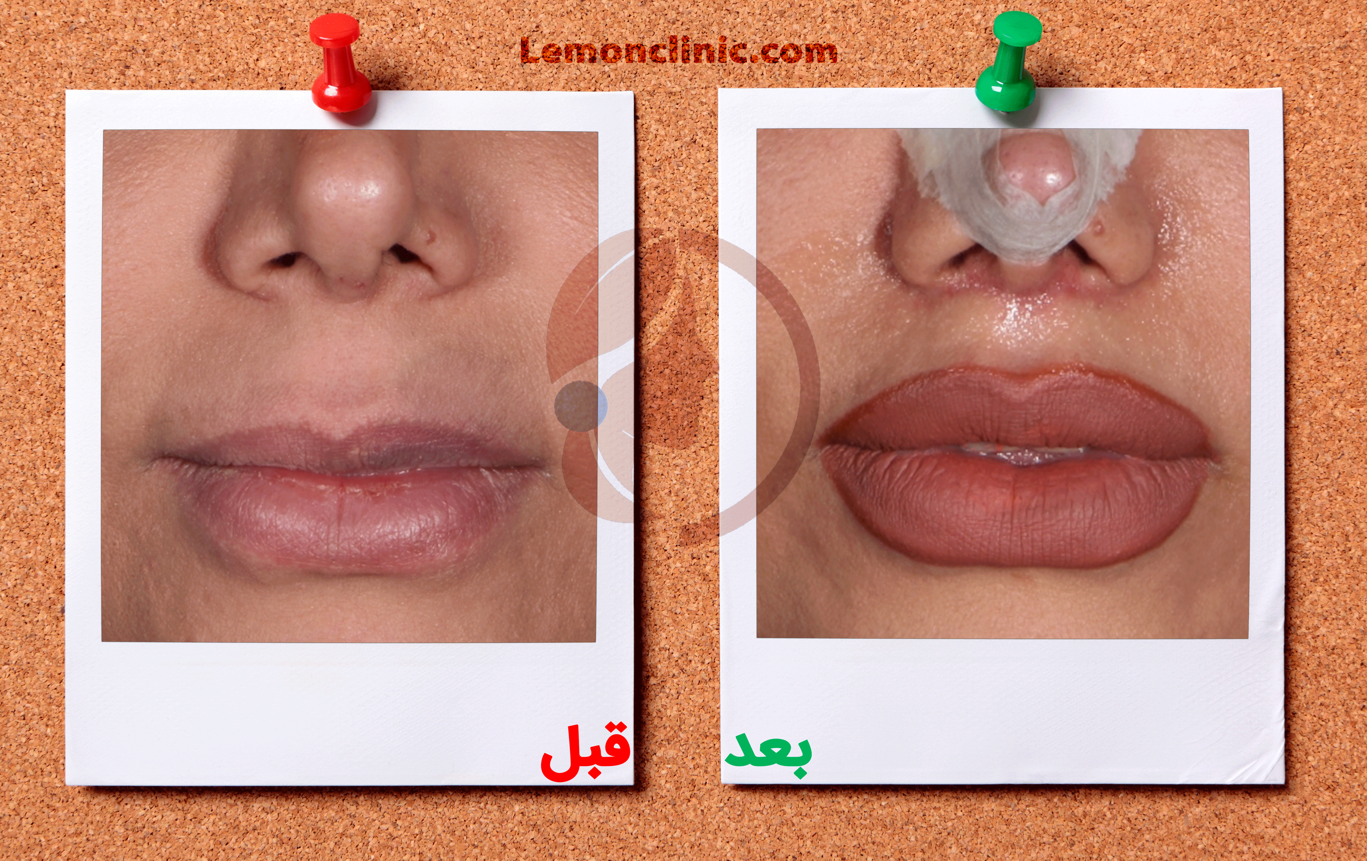عکس لیفت لب