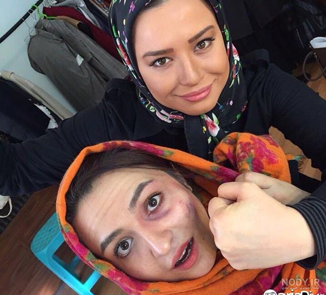 بیماری گلاره عباسی بیماری گلاره عباسی