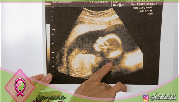 ضربان قلب جنین 152 نی نی سایت ضربان قلب جنین 152 نی نی سایت