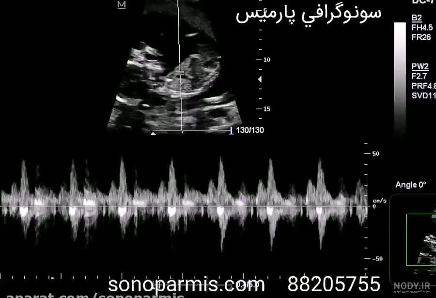 عکس سونوگرافی ضربان قلب جنین عکس سونوگرافی ضربان قلب جنین