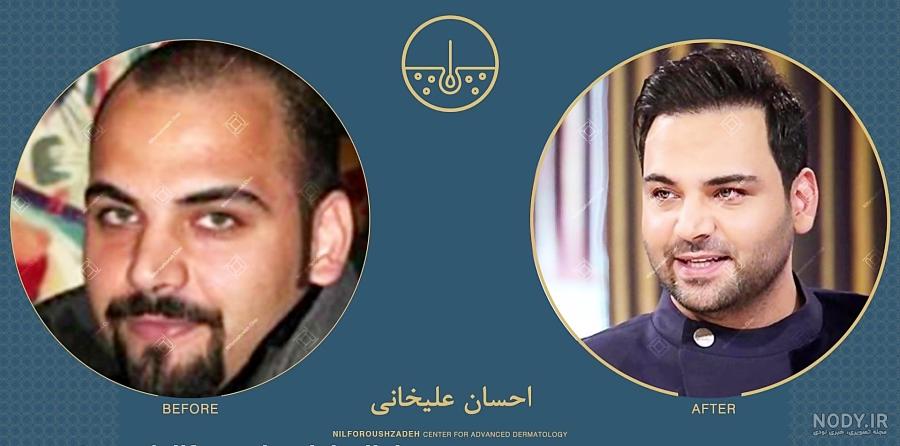 تصاویر احسان علیخانی قبل از کاشت مو