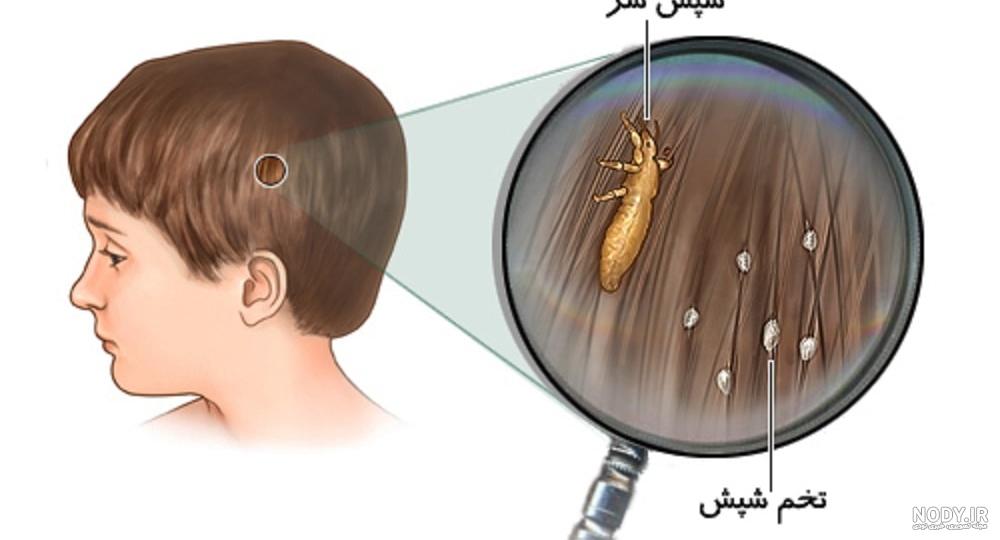 علائم شپش سر
