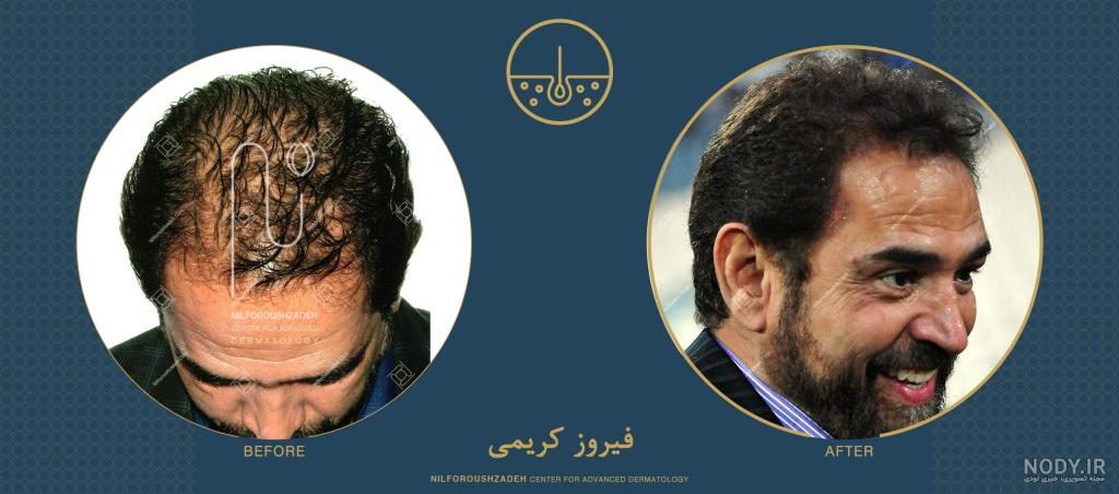 عکس احسان علیخانی قبل از عمل