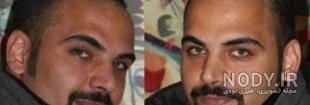 عکس احسان علیخانی قبل از عمل بینی و کاشت مو