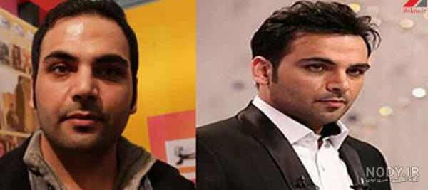 کاشت مو احسان علیخانی نی نی سایت