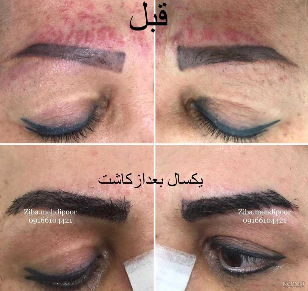 چه مدت بعد از کاشت ابرو ریزش شروع می‌شود