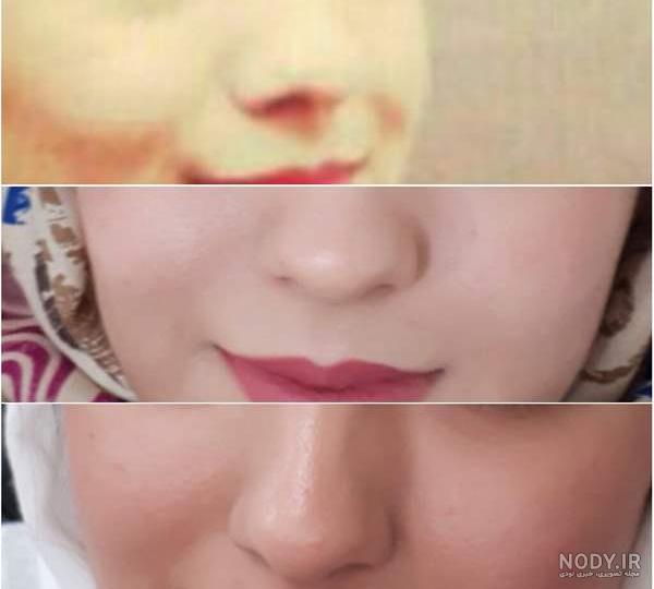 بینی عمل شده نی نی سایت