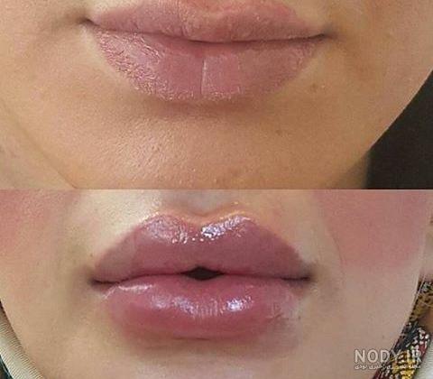 تزریق ژل لب مدل باربی تزریق ژل لب مدل باربی