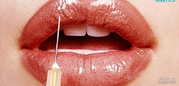 تزریق ژل لب مدل قلبی تزریق ژل لب مدل قلبی