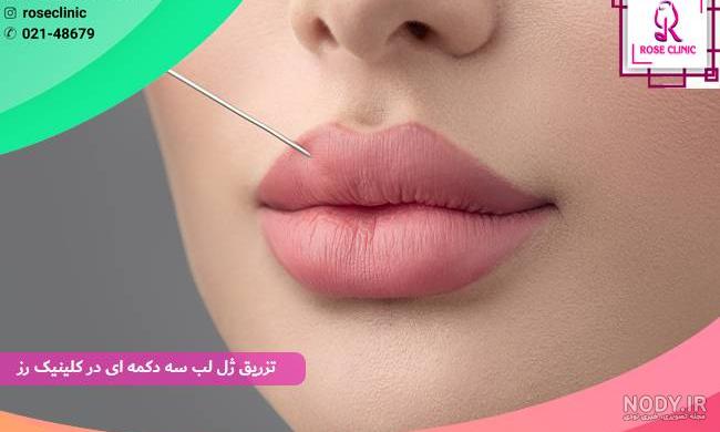 تزریق ژل لب مدل هالیوودی تزریق ژل لب مدل هالیوودی