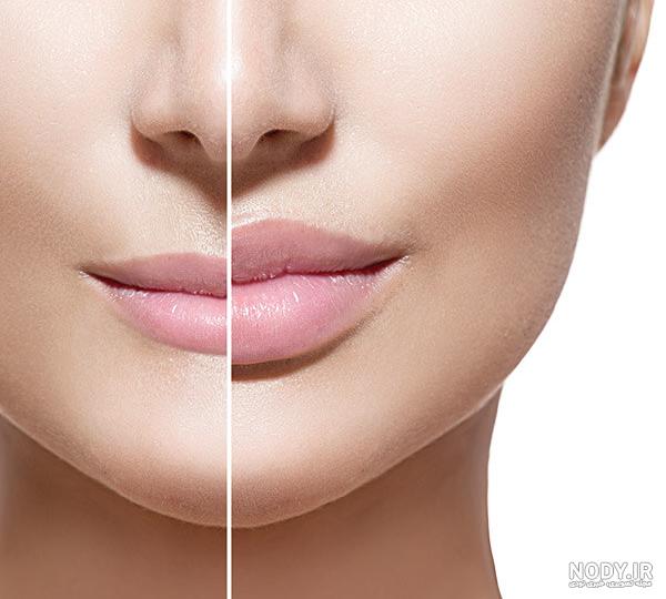 تزریق ژل لب مدل گرد تزریق ژل لب مدل گرد