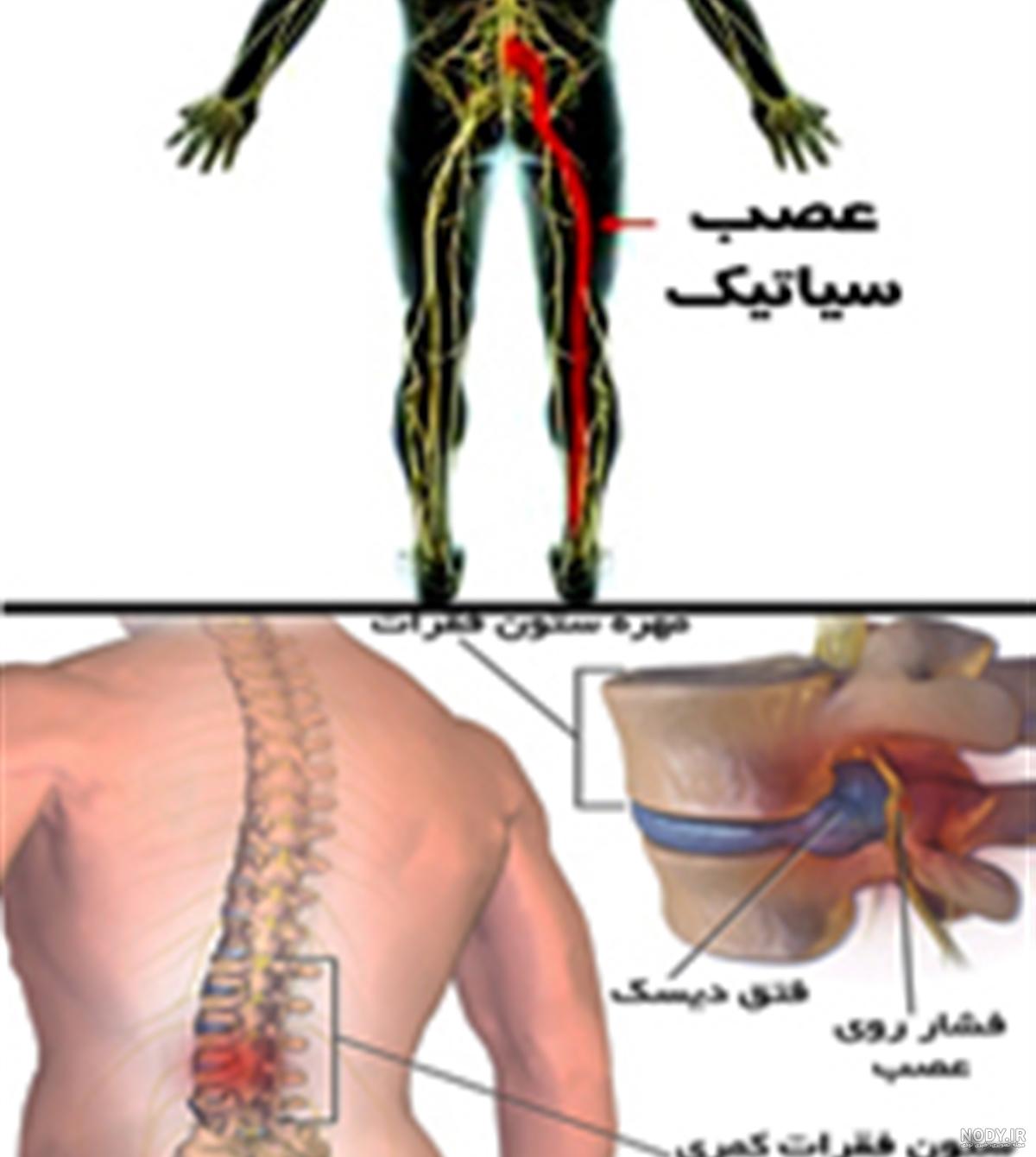 تشخیص سیاتیک با ام ار ای تشخیص سیاتیک با ام ار ای